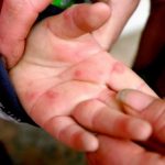 image-73220 Το Ygeiashmera.gr μας ενημερώνει: Τι πρέπει να ξέρετε για τον ιο κοξακι στα παιδιά